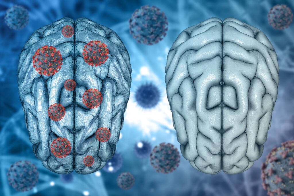 3d render medical background healthy brain diseased brain with covid 19 virus cells (1) (1)